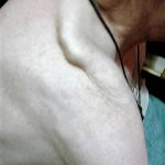 Deformidad y lesiones en un hombro de la víctima que dificultan sus movimientos y le causan fuertes dolores. PROPRONews