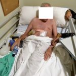 Situación actual de la víctima, con ileostomía por las secuelas del accidente. PROPRONews